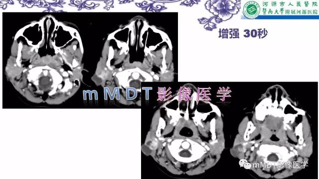 【PPT】鳃裂囊肿影像表现