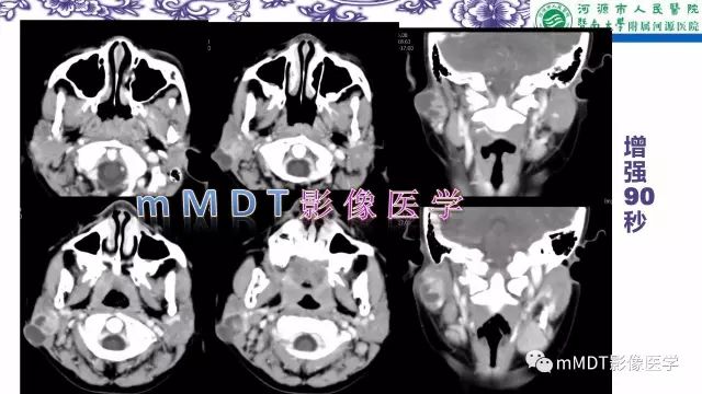 【PPT】鳃裂囊肿影像表现