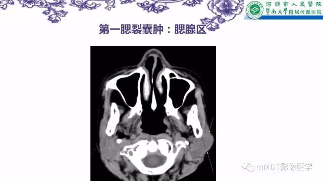 【PPT】鳃裂囊肿影像表现