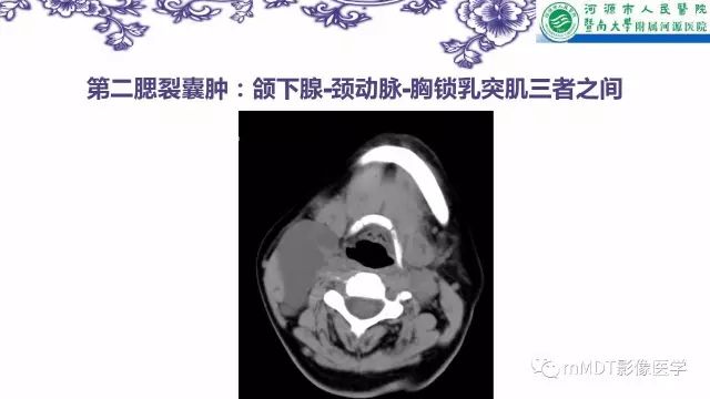 【PPT】鳃裂囊肿影像表现