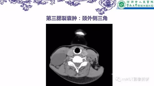 【PPT】鳃裂囊肿影像表现