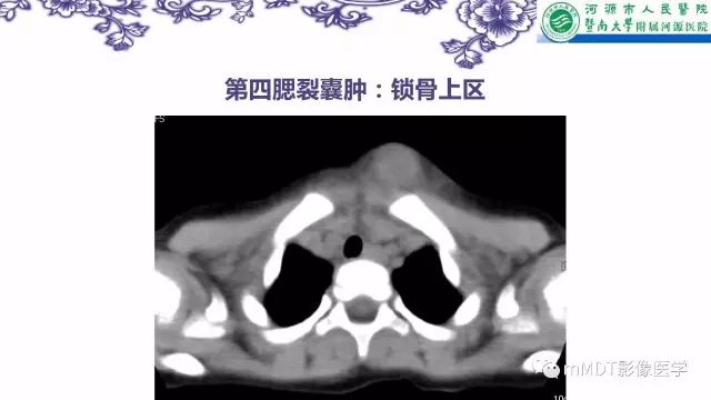 【PPT】鳃裂囊肿影像表现