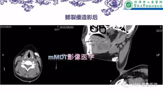 【PPT】鳃裂囊肿影像表现