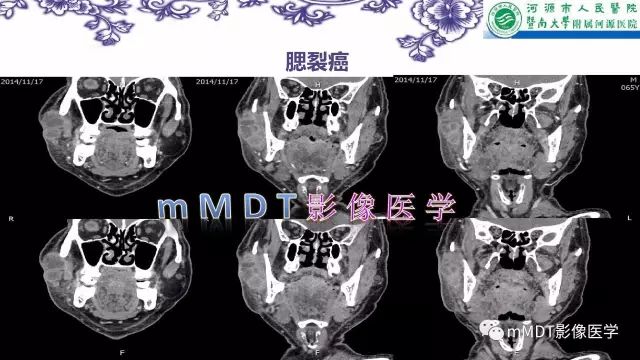 【PPT】鳃裂囊肿影像表现