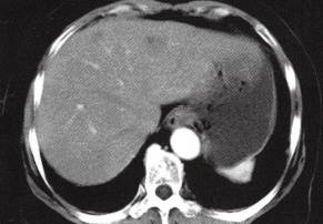 【病例】肝多发海绵状血管瘤1例CT 【病例】肝多发海绵状血管瘤1例CT