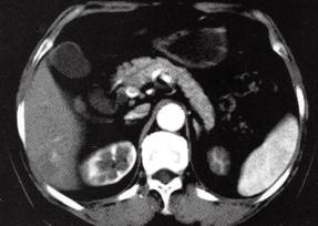 【病例】肝多发海绵状血管瘤1例CT 【病例】肝多发海绵状血管瘤1例CT