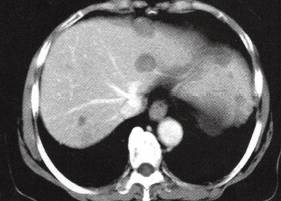【病例】肝多发海绵状血管瘤1例CT 【病例】肝多发海绵状血管瘤1例CT