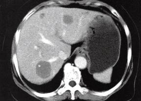 【病例】肝多发海绵状血管瘤1例CT 【病例】肝多发海绵状血管瘤1例CT