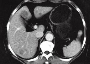 【病例】肝多发海绵状血管瘤1例CT 【病例】肝多发海绵状血管瘤1例CT