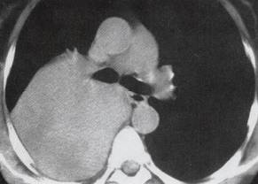 【病例】胸膜孤立性纤维瘤1例CT影像表现 【病例】胸膜孤立性纤维瘤1例CT影像表现
