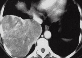 【病例】胸膜孤立性纤维瘤1例CT影像表现 【病例】胸膜孤立性纤维瘤1例CT影像表现