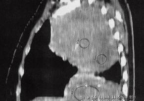 【病例】胸膜孤立性纤维瘤1例CT影像表现 【病例】胸膜孤立性纤维瘤1例CT影像表现
