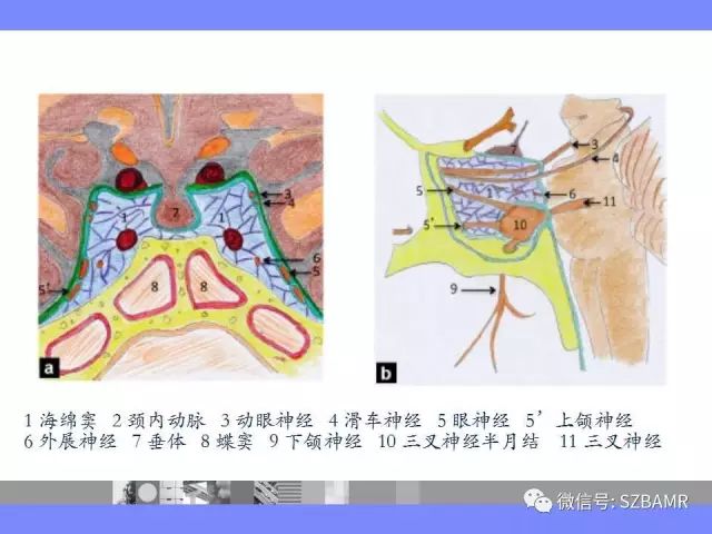 【PPT】海绵窦解剖及常见病变影像表现