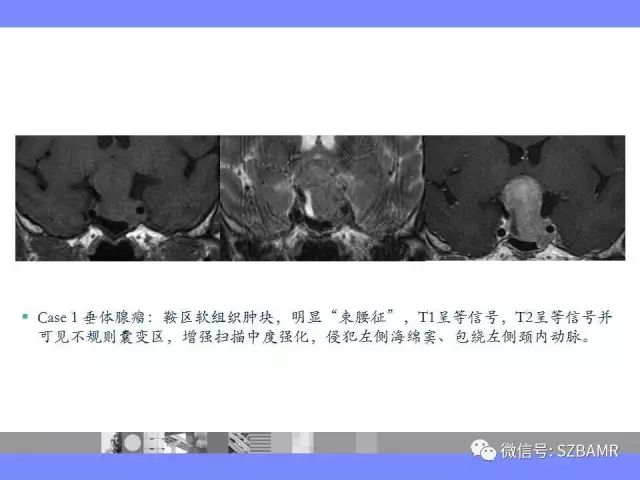 【PPT】海绵窦解剖及常见病变影像表现