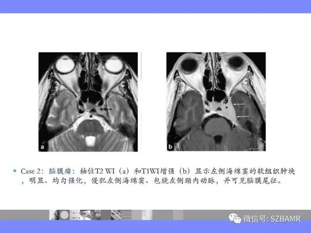 【PPT】海绵窦解剖及常见病变影像表现
