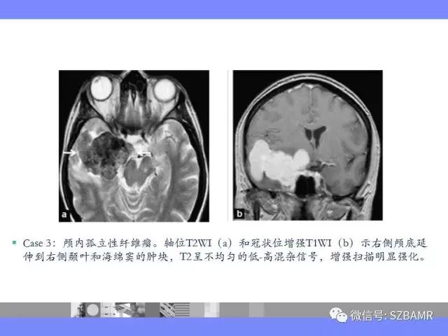 【PPT】海绵窦解剖及常见病变影像表现
