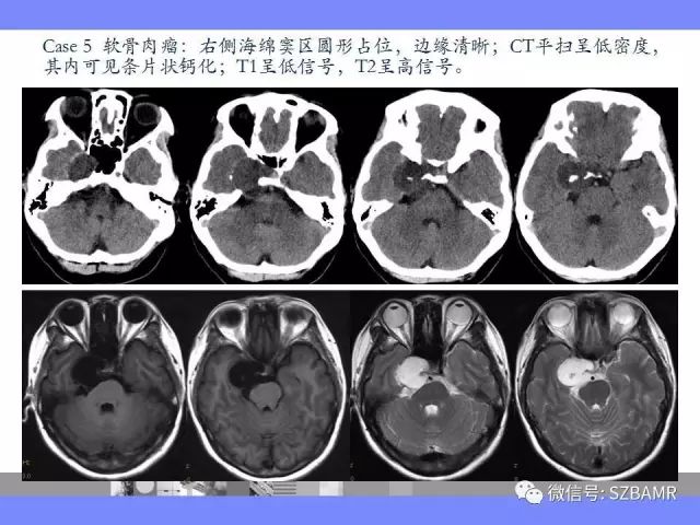 【PPT】海绵窦解剖及常见病变影像表现