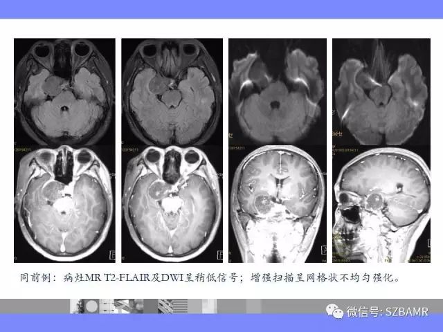 【PPT】海绵窦解剖及常见病变影像表现