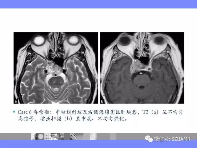 【PPT】海绵窦解剖及常见病变影像表现