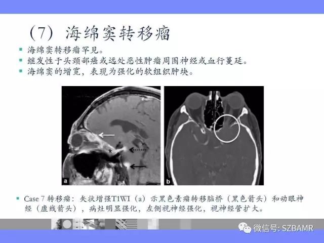 【PPT】海绵窦解剖及常见病变影像表现