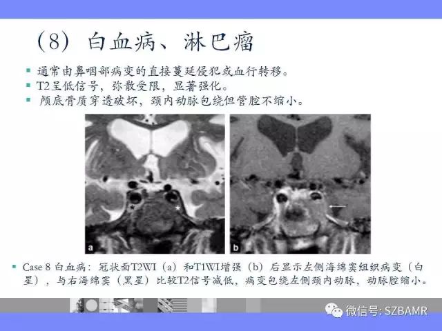 【PPT】海绵窦解剖及常见病变影像表现