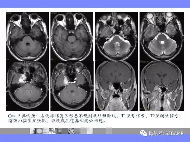 【PPT】海绵窦解剖及常见病变影像表现