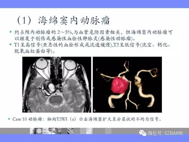 【PPT】海绵窦解剖及常见病变影像表现