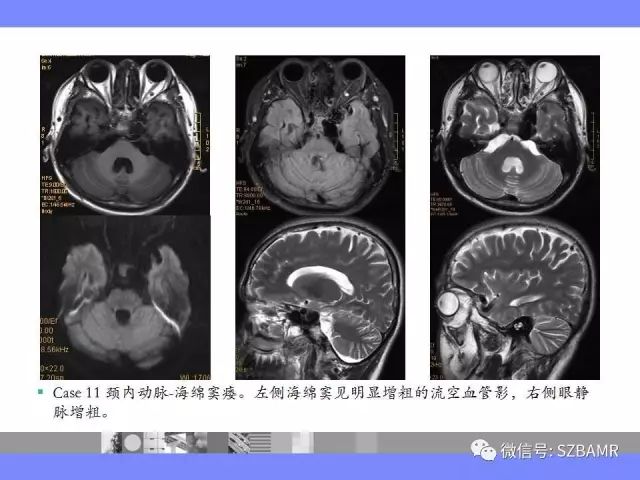 【PPT】海绵窦解剖及常见病变影像表现
