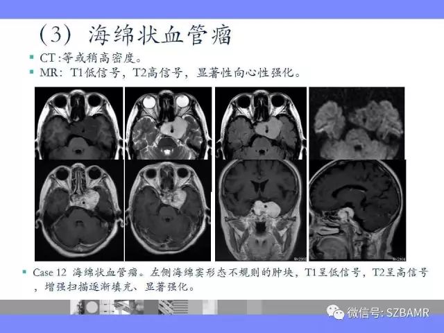 【PPT】海绵窦解剖及常见病变影像表现