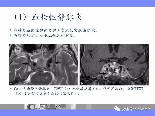 【PPT】海绵窦解剖及常见病变影像表现