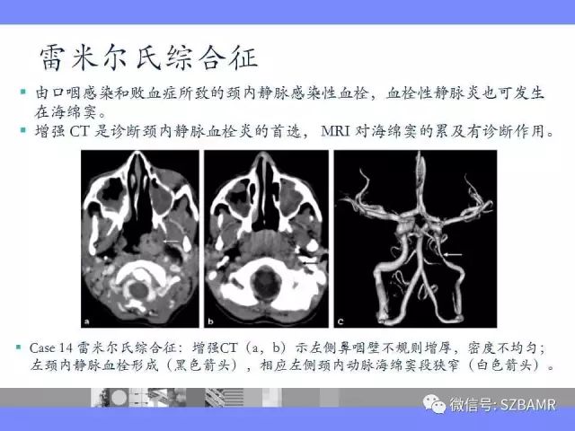 【PPT】海绵窦解剖及常见病变影像表现