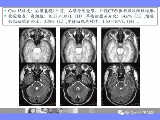 【PPT】海绵窦解剖及常见病变影像表现