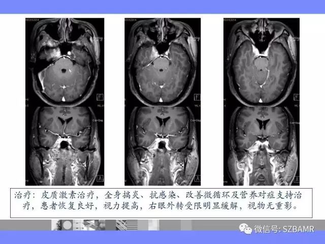 【PPT】海绵窦解剖及常见病变影像表现
