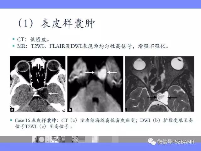 【PPT】海绵窦解剖及常见病变影像表现