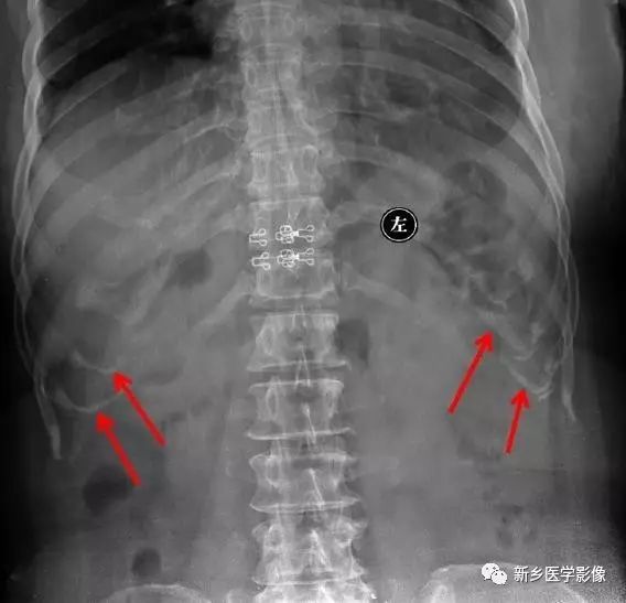 腹部平片看到高密度,你能想到这30种疾病吗? 腹部平片看到高密度,你能想到这30种疾病吗?
