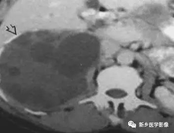 腹部平片看到高密度,你能想到这30种疾病吗? 腹部平片看到高密度,你能想到这30种疾病吗?
