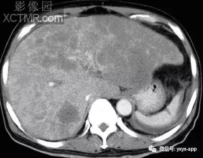 【病例】直肠癌1例X线CT影像表现 【病例】直肠癌1例X线CT影像表现
