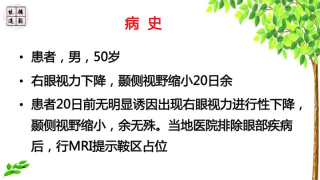 【病例】鞍区脊索瘤1例CT及MR影像表现