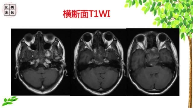 【病例】鞍区脊索瘤1例CT及MR影像表现