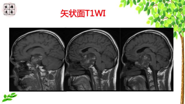 【病例】鞍区脊索瘤1例CT及MR影像表现