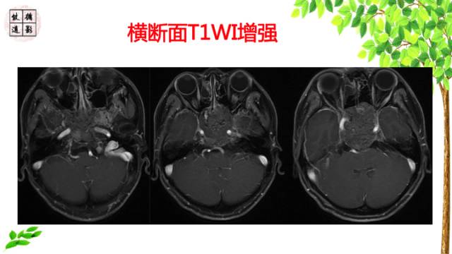 【病例】鞍区脊索瘤1例CT及MR影像表现