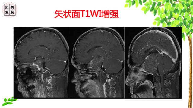 【病例】鞍区脊索瘤1例CT及MR影像表现