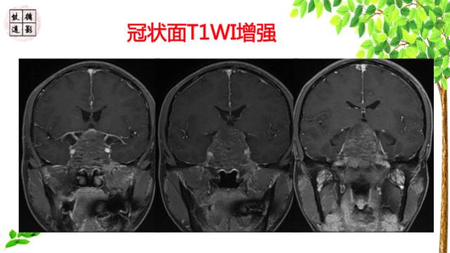 【病例】鞍区脊索瘤1例CT及MR影像表现