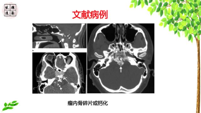 【病例】鞍区脊索瘤1例CT及MR影像表现