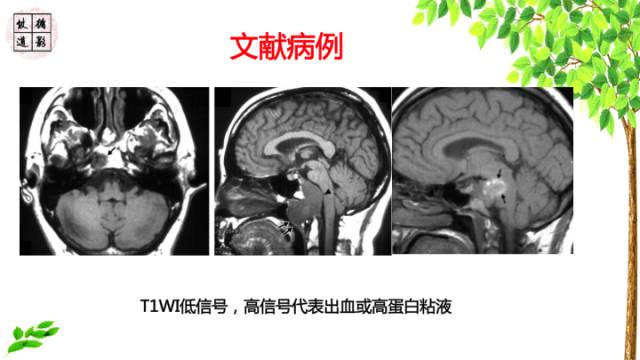 【病例】鞍区脊索瘤1例CT及MR影像表现