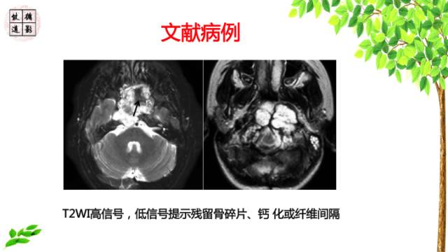 【病例】鞍区脊索瘤1例CT及MR影像表现