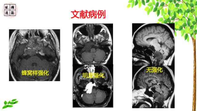 【病例】鞍区脊索瘤1例CT及MR影像表现