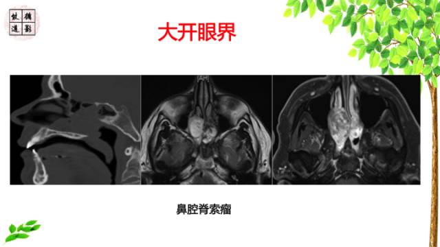 【病例】鞍区脊索瘤1例CT及MR影像表现
