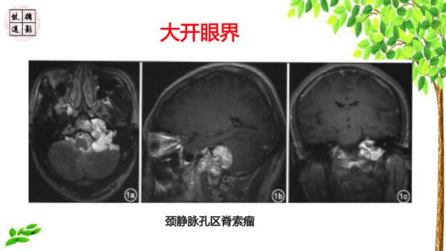 【病例】鞍区脊索瘤1例CT及MR影像表现
