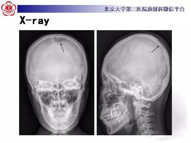 【病例】颅骨巨细胞修复性肉芽肿1例X线CT